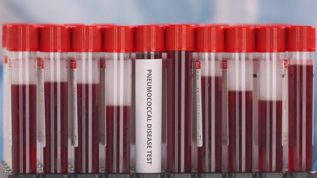 Hand wearing protection glove puts vial with pneumococcal disease test in the tube rack
