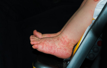 A young boy with Hand, Foot and Mouth disease.