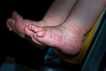 A young boy with Hand, Foot and Mouth disease.
