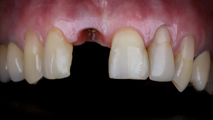 the upper jaw of the patient without a crown, before installation