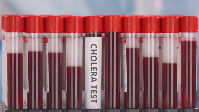 Laboratory worker wearing protection glove puts laboratory tube with cholera test in the tube rack
