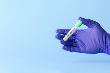 test tube in hand of lab technician with sample of coronavirus covid-19, deadly global pandemic concept