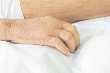 .Patient's hands and subcutaneous swelling. Chronic renal failure and degenerative symptoms of...