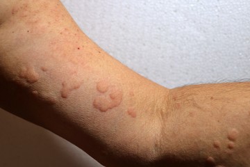 Urticaria on arm of a man.