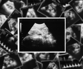 ultrasound picture of a child