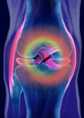 Kreuzbandriss Knie, Schmerzzone, Illustration, Computertomographie 