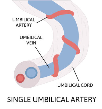 Single umbilical artery. anatomy of umbilical cord with one umbilical artery and one umbilical vien.