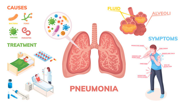 Pneumonia lungs disease vector infographics on symptoms, cause and medical treatment. Pneumonia lungs infection bacteria and viruses, disease symptoms, transmission prevention and hospitalization