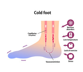 Cold foot blood circulation illustration (sensitivity to cold, cold toes)