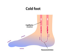 Cold foot blood circulation illustration (sensitivity to cold, cold toes)