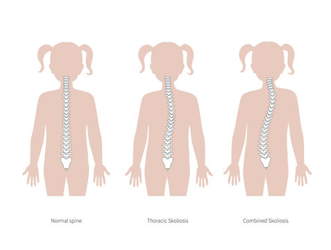 Scoliosis flat vector illustration