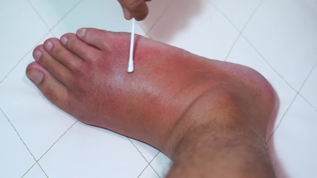 Close up old man right foot, Ankle wounded waiting and swelling infectious disease by bee sting allergic reactions nurse treatment on wound dressing a bloody and brine of patient on white background.