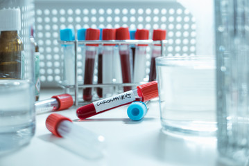 Positive / Negative COVID-19 test and laboratory sample of blood testing for diagnosis new Corona virus infection. Epidemic virus Respiratory Syndrome. Hospital background.