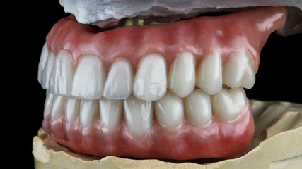 high-quality dental prosthesis of the lower and upper jaws on the dental model in the bite, side view © Dental Pro Content