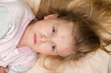 Little baby girl lies on a bed with chickenpox
