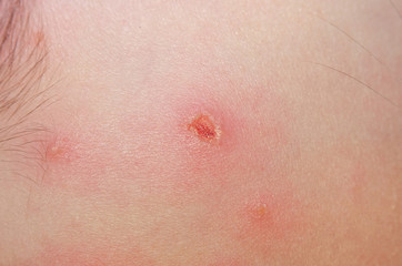 Chickenpox on the baby's skin close-up