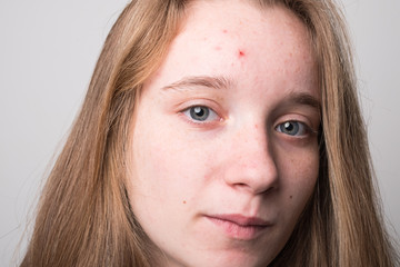 Teen girl in acne. Studio image of a pretty young girl with acne face.