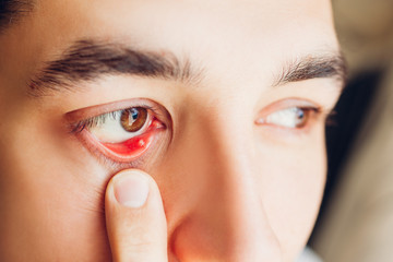 Infected sty barley purulent eye. Man pulls down lower eyelid showing inflammation pus caused by...