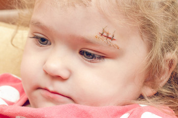 A little girl with a scar above her eyebrow, a deep wound sewn up