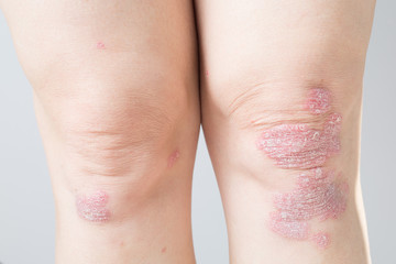 Acute psoriasis on the knees is an autoimmune incurable dermatological skin disease. Large red, inflamed, flaky rash on the knees. Joints affected by psoriatic arthritis.Close up - obrazy, fototapety, plakaty