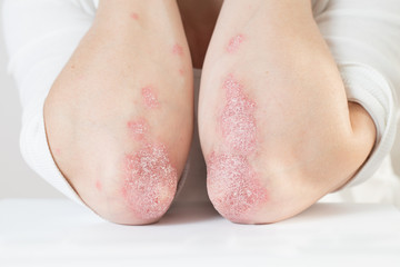 Acute psoriasis on the elbows is an autoimmune incurable dermatological skin disease. Large red, inflamed, flaky rash on the knees. Joints affected by psoriatic arthritis - obrazy, fototapety, plakaty