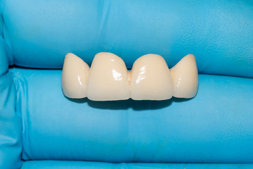 ceramic denture. Ceramic-metal bridge of human teeth in the hands of a dentist in blue gloves. Close-up. Macro.