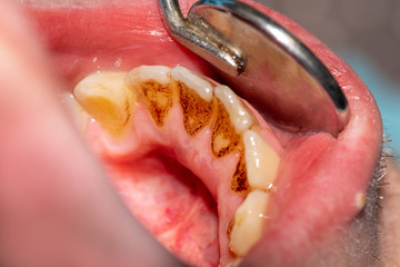 poor dental hygiene. Plaque on teeth after smoking cigarettes and not observing toothbrushing