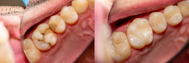 Dental caries. Filling with dental composite photopolymer material using rabbders. The concept of...