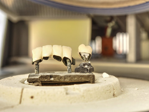 Tooth, metal ceramic crown on the table.
