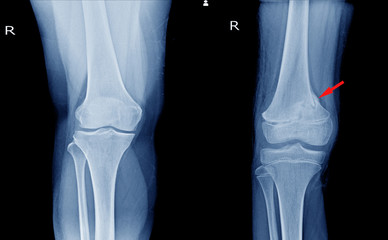 X-ray Knee AP views Showing  Normal knee joint and fracture distal femur.