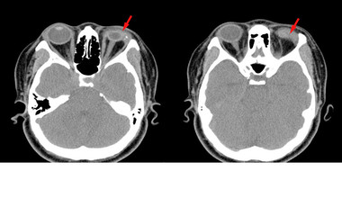 CT-Scan brain and orbit Impression: Rupture of Lt eye globe with Dislocation or destruction of the lens.Medical healthcare concept. © Richman Photo