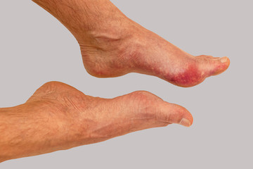 Foot disease Rheumatism and gout. Red leg swelling. Pain in the foot.