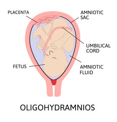 Oligohydramnios, deficiency of amniotic fluid. Parts of pregnancy are marked with line
