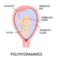 Polyhydramnios. excess of amniotic fluid in the amniotic sac.