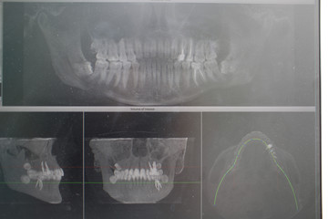 X-ray of the jaw in the dental clinic