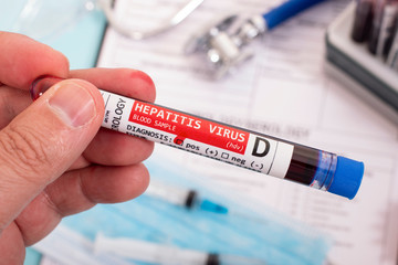 Fototapeta premium Blood samples with infected virus