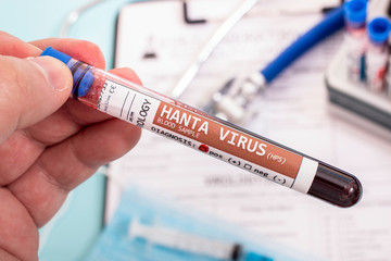 Fototapeta premium Blood samples with infected virus