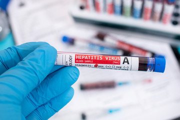 Fototapeta premium Blood samples with infected virus