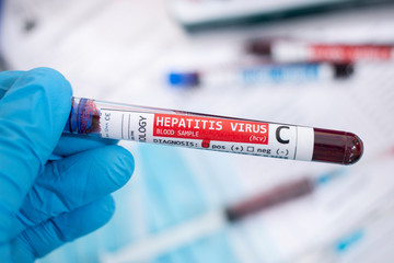 Fototapeta premium Blood samples with infected virus