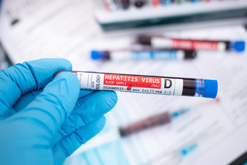 Fototapeta premium Blood samples with infected virus