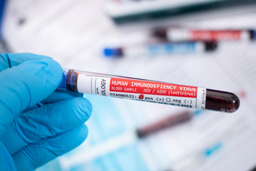 Fototapeta premium Blood samples with infected virus