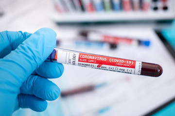 Fototapeta premium Blood samples with infected virus