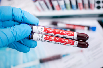 Fototapeta premium Blood samples with infected virus