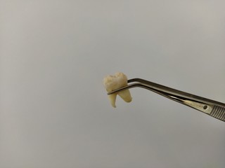 Removed tooth in tweezers on a white background © Alex Milan