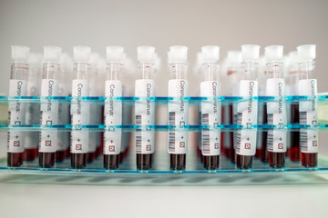Positive results of corona virus tests. Many blood test tube in the laboratory.