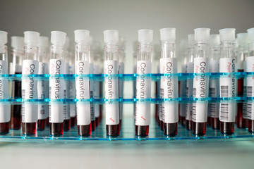Positive results of corona virus tests. Many blood test tube in the laboratory.