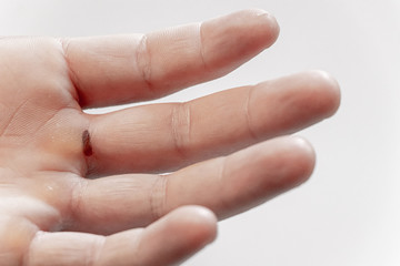 Hand with blister and callus on white background