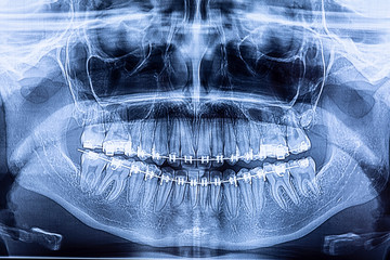 Dental radiography with braces