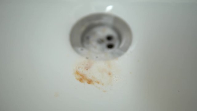 drops of the fresh blood falling on the drain on sink while brushing teeth
