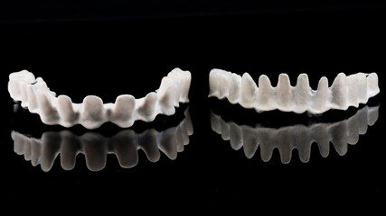 two dental titanium beams with Apak material on the lower and upper jaws of the patient, taken with reflection © Dental Pro Content